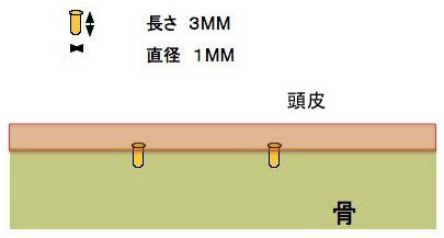チタンペック1