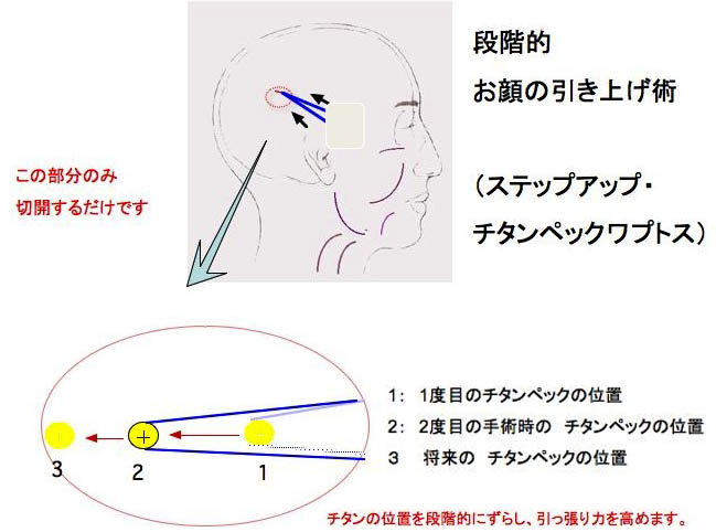 チタンペック1