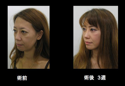 術後