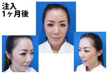 注入一ヶ月後